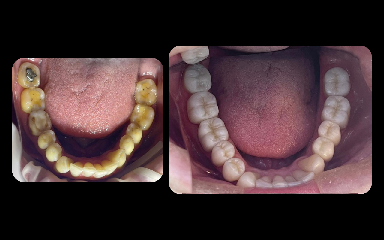 Reabilitação Estética e Oclusal realizada pela Dra. Fabiola Roggia em Porto Alegre